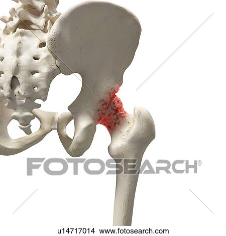 Picture - Arthritis in the hip, illustration.. Fotosearch