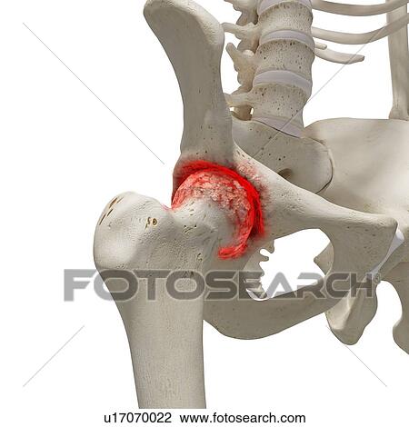 Stock Image - Arthritis in the hip, illustration.. Fotosearch