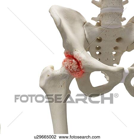 Stock Image - Arthritis in the hip, illustration.. Fotosearch