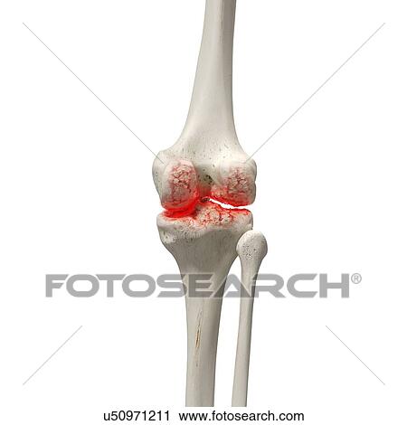 Stock Image - Arthritis in the knee, illustration.. Fotosearch