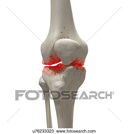 Arthritis in the knee, illustration. View Large Photo Image Stock Image - Arthritis in the knee, illustration.. Fotosearch