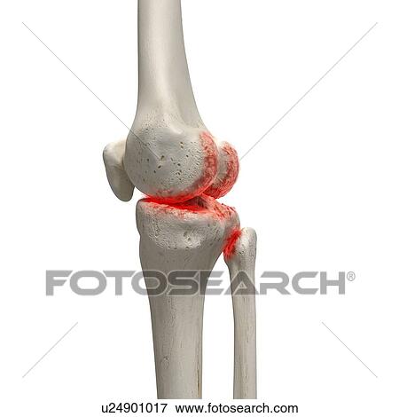 Stock Photo - Arthritis in the knee, illustration.. Fotosearch