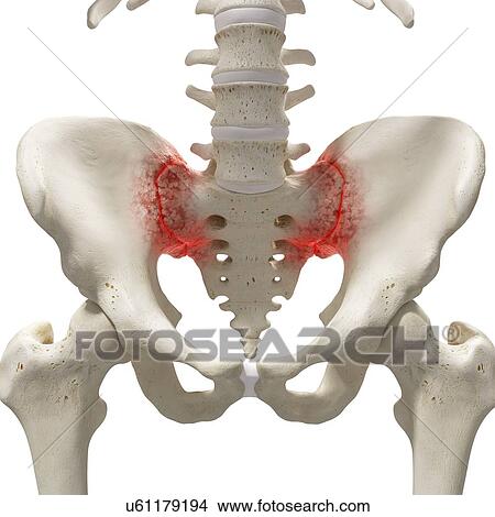 Picture - Arthritis in the sacrum, illustration.. Fotosearch