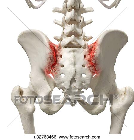 Arthritis in the sacrum, illustration. View Large Photo Image Stock Photograph - Arthritis in the sacrum, illustration.. Fotosearch