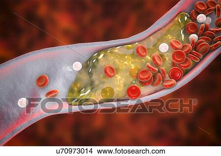 Atheromatous plaque inside blood vessel, computer illustration. A cholesterol atheroma is causing a narrowing of an artery (atherosclerosis). View Large Photo Image Picture - Atheromatous plaque inside blood vessel, computer illustration. A cholesterol atheroma is causing a narrowing of an artery (atherosclerosis).. Fotosearch