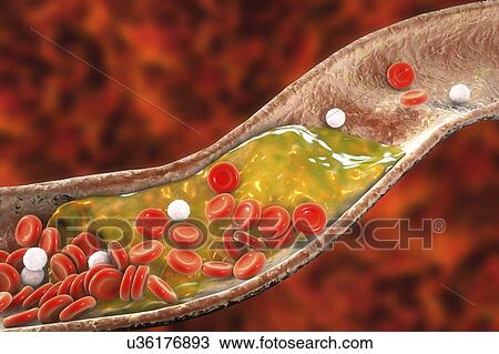 Atheromatous plaque inside blood vessel, computer illustration. A cholesterol atheroma is causing a narrowing of an artery (atherosclerosis). View Large Photo Image Stock Image - Atheromatous plaque inside blood vessel, computer illustration. A cholesterol atheroma is causing a narrowing of an artery (atherosclerosis).. Fotosearch