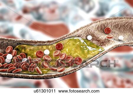 Stock Image - Atheromatous plaque inside blood vessel, computer illustration. A cholesterol atheroma is causing a narrowing of an artery (atherosclerosis).. Fotosearch