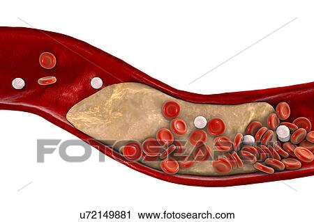Stock Image - Atheromatous plaque inside blood vessel, computer illustration. A cholesterol atheroma is causing a narrowing of an artery (atherosclerosis).. Fotosearch
