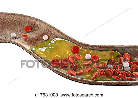 Stock Photo - Atheromatous plaque inside blood vessel, computer illustration. A cholesterol atheroma is causing a narrowing of an artery (atherosclerosis).. Fotosearch