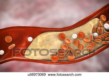 Stock Photo - Atheromatous plaque inside blood vessel, computer illustration. A cholesterol atheroma is causing a narrowing of an artery (atherosclerosis).. Fotosearch