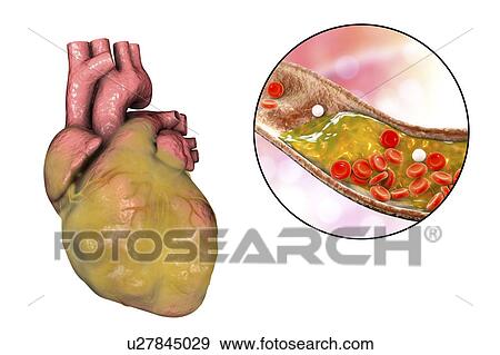 Computer illustration of a fatty heart and a coronary artery narrowed by a fatty plaque. View Large Photo Image Stock Photo - Computer illustration of a fatty heart and a coronary artery narrowed by a fatty plaque.. Fotosearch