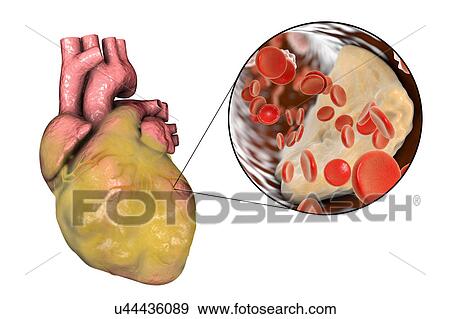 Computer illustration of a fatty heart and a coronary artery narrowed by a fatty plaque. View Large Photo Image Stock Photo - Computer illustration of a fatty heart and a coronary artery narrowed by a fatty plaque.. Fotosearch