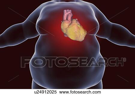 Computer illustration of a fatty heart in an overweight man. View Large Photo Image Stock Photography - Computer illustration of a fatty heart in an overweight man.. Fotosearch