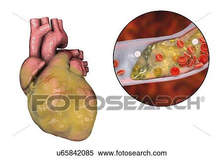 Computer illustration of a fatty heart and a coronary artery narrowed by a fatty plaque. View Large Photo Image Stock Photography - Computer illustration of a fatty heart and a coronary artery narrowed by a fatty plaque.. Fotosearch