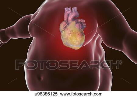 Computer illustration of a fatty heart in an overweight man. View Large Photo Image Stock Photography - Computer illustration of a fatty heart in an overweight man.. Fotosearch