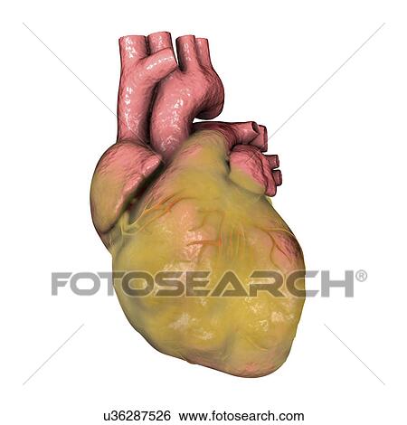 Stock Photograph - Fatty heart, computer illustration.. Fotosearch