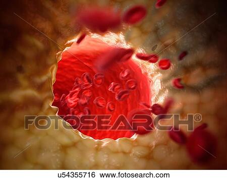 Stock Photograph - Fatty human artery, illustration.. Fotosearch