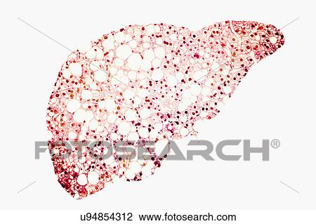 Stock Image - Fatty liver, conceptual illustration. Fatty liver is commonly associated with alcohol or metabolic syndrome (diabetes, hypertension and obesity), but can also be due to any one of many causes. Fatty liver disease is a reversible condition wherein.... Fotosearch