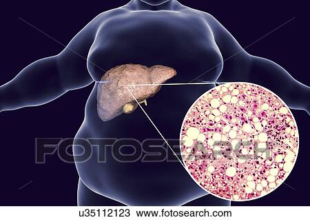 Stock Image - Fatty liver, illustration and micrograph. Fotosearch