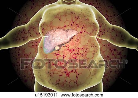Stock Image - Fatty liver in obese person, conceptual illustration. Fatty liver is commonly associated with alcohol or metabolic syndrome (diabetes, hypertension and obesity), but can also be due to any one of many causes. Fatty liver disease is a reversible.... Fotosearch
