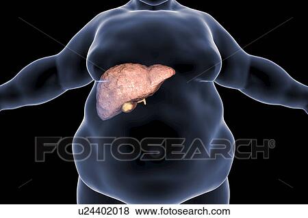 Fatty liver in obese person, conceptual illustration. Fatty liver is commonly associated with alcohol or metabolic syndrome (diabetes, hypertension and obesity), but can also be due to any one of many causes. Fatty liver disease is a reversible... View Large Photo Image Stock Photo - Fatty liver in obese person, conceptual illustration. Fatty liver is commonly associated with alcohol or metabolic syndrome (diabetes, hypertension and obesity), but can also be due to any one of many causes. Fatty liver disease is a reversible.... Fotosearch