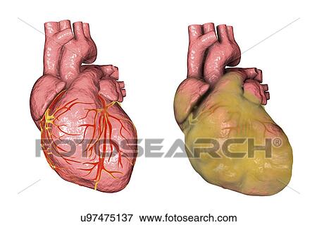 Healthy heart (left) and heart with left ventricular hypertrophy and fat layer (right), computer illustration. View Large Photo Image Stock Photo - Healthy heart (left) and heart with left ventricular hypertrophy and fat layer (right), computer illustration.. Fotosearch
