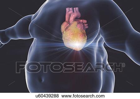 Stock Photo - Heart attack in obese man, computer illustration.. Fotosearch