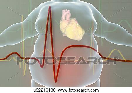 Heart attack in obese man. Conceptual illustration showing a fatty heart in an overweight man and an electrocardiogram with signs of myocardial infarction (heart attack). View Large Photo Image Stock Photograph - Heart attack in obese man. Conceptual illustration showing a fatty heart in an overweight man and an electrocardiogram with signs of myocardial infarction (heart attack).. Fotosearch
