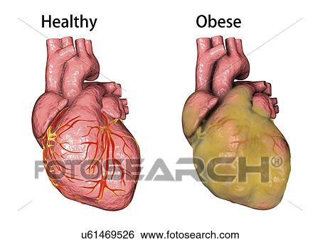 Heart of a healthy person (left) and an overweight person (right, obese heart), computer illustration. View Large Photo Image Stock Photograph - Heart of a healthy person (left) and an overweight person (right, obese heart), computer illustration.. Fotosearch