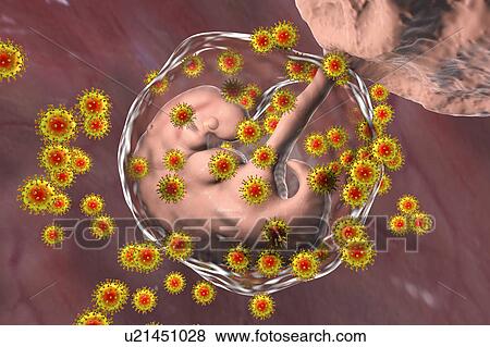 Stock Photo - Human immunodeficiency viruses (HIV) infecting human embryo, conceptual illustration. The embryo is 4 weeks old.. Fotosearch