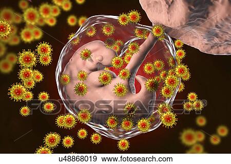 Stock Photo - Human immunodeficiency viruses (HIV) infecting human embryo, conceptual illustration. The embryo is 4 weeks old.. Fotosearch