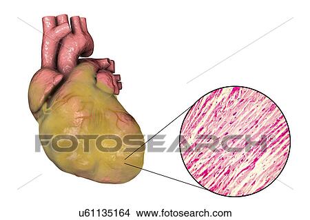 Illustration of a fatty heart with left ventricular hypertrophy and light micrograph of hypertrophic cardiac tissue. View Large Photo Image Picture - Illustration of a fatty heart with left ventricular hypertrophy and light micrograph of hypertrophic cardiac tissue.. Fotosearch