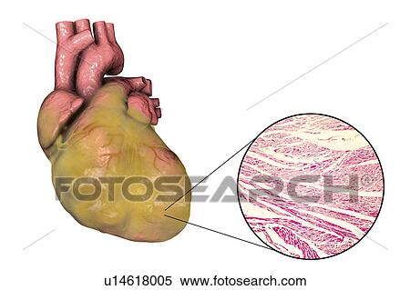 Stock Photography - Illustration of a fatty heart with left ventricular hypertrophy and light micrograph of hypertrophic cardiac tissue.. Fotosearch