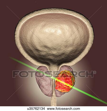 Picture - Laserotherapy of prostate cancer, conceptual illustration.. Fotosearch