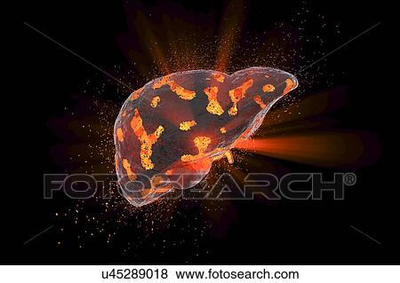 Stock Photo - Liver disease, conceptual illustration. Fotosearch