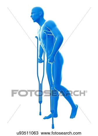 Man on crutches, illustration. View Large Photo Image Stock Image - Man on crutches, illustration.. Fotosearch