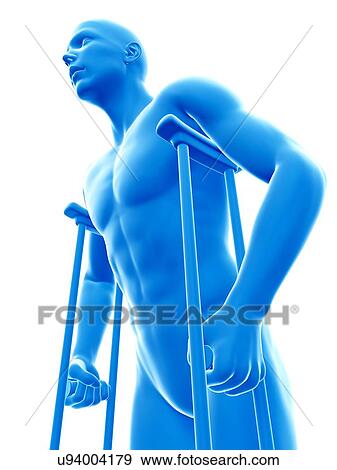 Man on crutches, illustration. View Large Photo Image Stock Photo - Man on crutches, illustration.. Fotosearch