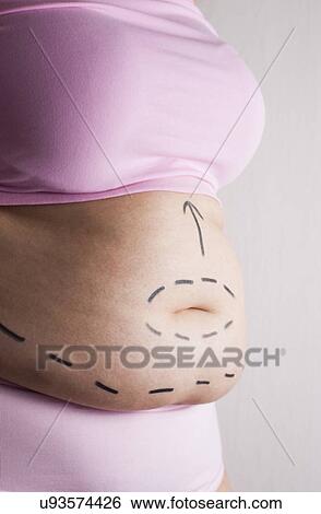 MODEL RELEASED. Woman with pen marks on her abdomen in preparation for surgery. View Large Photo Image Stock Photograph - MODEL RELEASED. Woman with pen marks on her abdomen in preparation for surgery.. Fotosearch