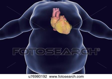 Obese man's heart, computer illustration. View Large Photo Image Stock Image - Obese man's heart, computer illustration.. Fotosearch