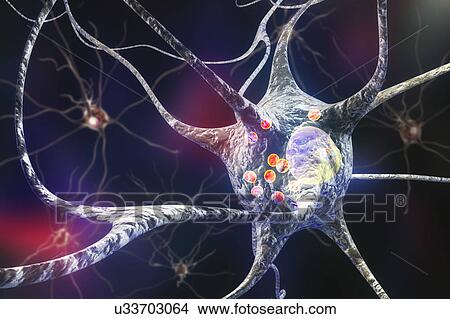 Parkinson's disease nerve cells. Computer illustration of human nerve cells affected by Lewy bodies (small red spheres inside cytoplasm of neurons) in the brain of a patient with Parkinson's disease. Lewy bodies are abnormal accumulations of protein... View Large Photo Image Picture - Parkinson's disease nerve cells. Computer illustration of human nerve cells affected by Lewy bodies (small red spheres inside cytoplasm of neurons) in the brain of a patient with Parkinson's disease. Lewy bodies are abnormal accumulations of protein.... Fotosearch
