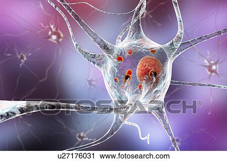Stock Image - Parkinson's disease nerve cells. Computer illustration of human nerve cells affected by Lewy bodies (small red spheres inside cytoplasm of neurons) in the brain of a patient with Parkinson's disease. Lewy bodies are abnormal accumulations of protein.... Fotosearch
