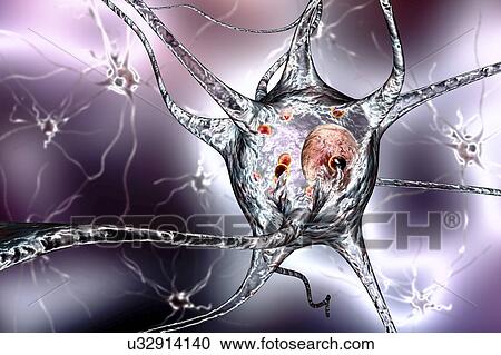 Stock Image - Parkinson's disease nerve cells. Computer illustration of human nerve cells affected by Lewy bodies (small red spheres inside cytoplasm of neurons) in the brain of a patient with Parkinson's disease. Lewy bodies are abnormal accumulations of protein.... Fotosearch
