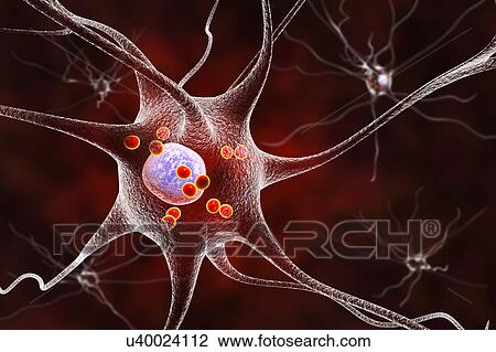 Parkinson's disease nerve cells. Computer illustration of human nerve cells affected by Lewy bodies (small red spheres inside cytoplasm of neurons) in the brain of a patient with Parkinson's disease. Lewy bodies are abnormal accumulations of protein... View Large Photo Image Stock Image - Parkinson's disease nerve cells. Computer illustration of human nerve cells affected by Lewy bodies (small red spheres inside cytoplasm of neurons) in the brain of a patient with Parkinson's disease. Lewy bodies are abnormal accumulations of protein.... Fotosearch