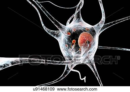 Parkinson's disease nerve cells. Computer illustration of human nerve cells affected by Lewy bodies (small red spheres inside cytoplasm of neurons) in the brain of a patient with Parkinson's disease. Lewy bodies are abnormal accumulations of protein... View Large Photo Image Stock Photo - Parkinson's disease nerve cells. Computer illustration of human nerve cells affected by Lewy bodies (small red spheres inside cytoplasm of neurons) in the brain of a patient with Parkinson's disease. Lewy bodies are abnormal accumulations of protein.... Fotosearch