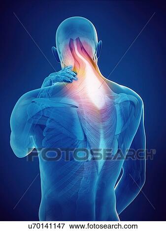 Stock Photo - Person with neck pain, illustration.. Fotosearch