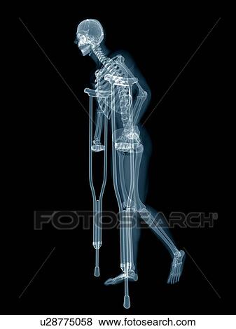 Skeletal system of someone on crutches, illustration. View Large Photo Image Stock Photo - Skeletal system of someone on crutches, illustration.. Fotosearch