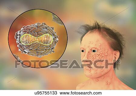 Stock Image - Smallpox virus and disease, illustration. A viral membrane (transparent) derived from its host cell covers the virus particle. Inside this lies the core (red), which contains the particle's DNA (deoxyribonucleic acid) genetic material. The core has a.... Fotosearch