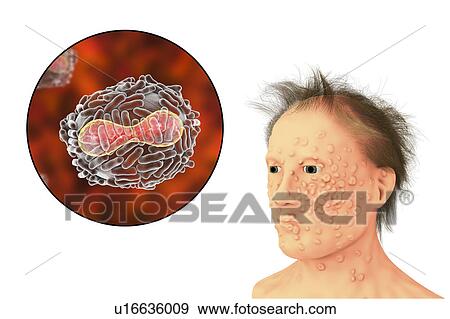 Stock Photo - Smallpox virus and disease, illustration. A viral membrane (transparent) derived from its host cell covers the virus particle. Inside this lies the core (red), which contains the particle's DNA (deoxyribonucleic acid) genetic material. The core has a.... Fotosearch