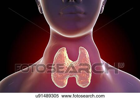 Stock Photography - Thyrotoxic goitre (goitre), illustration. Goitre (swollen neck) seen on a woman patient suffering from an overactive thyroid gland. A goitre is caused by the enlargement of the thyroid gland and may vary in size from a small lump to an enormous.... Fotosearch
