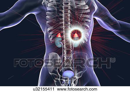 Stock Image - Treatment of adrenal gland disease, illustration. Fotosearch